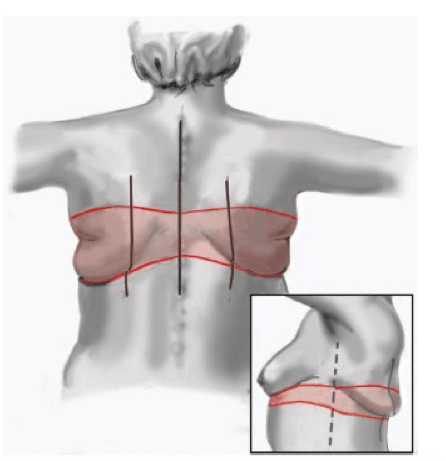 Nordesthetics clinic - Upper back lift is a surgery which is performed when  a patient has skin hanging on the back. This usually happens after massive  weight loss in a short period
