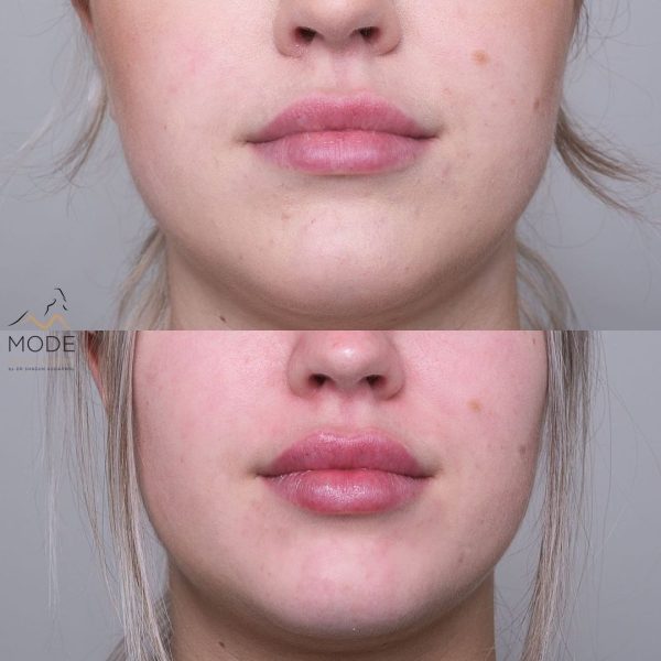 Lip Fillers Before And After Mode Plastic Surgery 6682