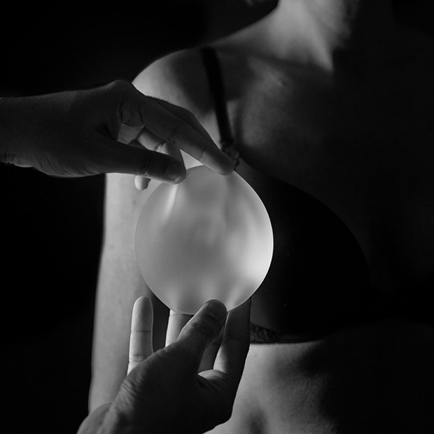 Breast Implant Revision Sydney